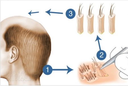 maladie de cheveux, perte de cheveux, alopécie, cuir chevelu, transplantation capillaire, chauve,transplant cheveux