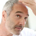 pertes de cheveux, Alopécie,perte de cheveux, cheveux qui tombent, quoi faire avec cheveux qui tombent, masque cheveux, santé de cheveux