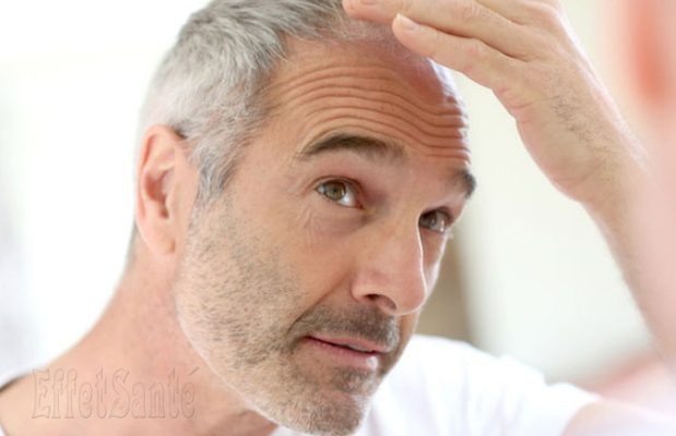 pertes de cheveux, Alopécie,perte de cheveux, cheveux qui tombent, quoi faire avec cheveux qui tombent, masque cheveux, santé de cheveux