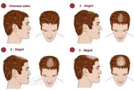 pertes de cheveux, Alopécie,perte de cheveux, cheveux qui tombent, quoi faire avec cheveux qui tombent, masque cheveux, santé de cheveux