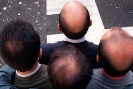 maladie de cheveux, perte de cheveux, alopécie, cuir chevelu, transplantation capillaire, chauve,