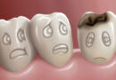les caries chez les enfants, caries et les dents, carie, carie dent de lait, comment traiter les caries