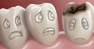 les caries chez les enfants, caries et les dents, carie, carie dent de lait, comment traiter les caries