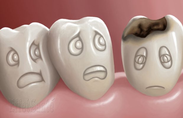 les caries chez les enfants, caries et les dents, carie, carie dent de lait, comment traiter les caries