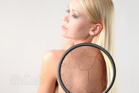 peau sèche, cheveux fragiles,psoriasis,ongles cassants, manger du sel,