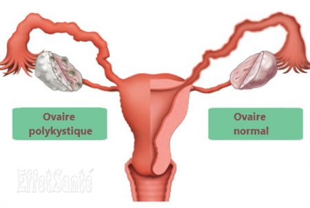 ovaires polykistiques, syndrome ovaire polykistiques