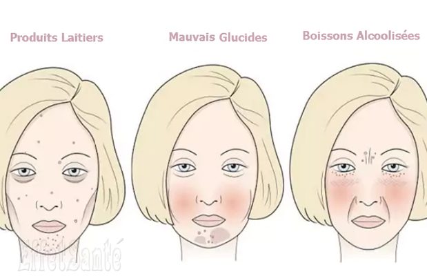 mauvais glucides, produits laitiers, santé de la peau, acné, sébum