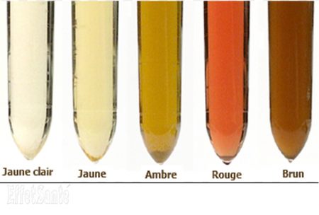 urine, couleur d'urine, urine, maladie