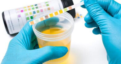 urine, couleur d'urine, urine, maladie