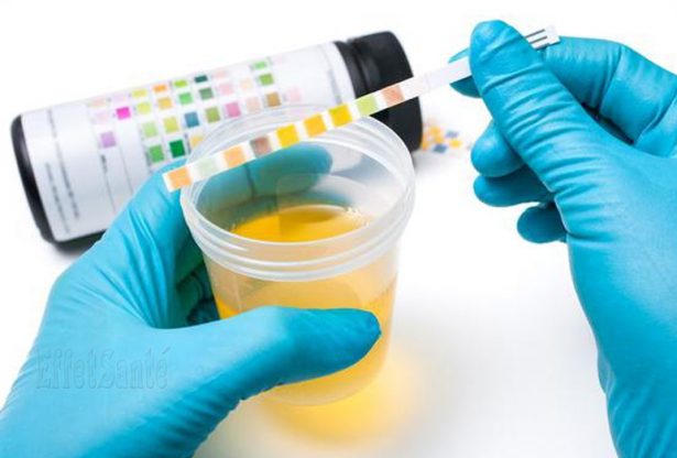 urine, couleur d'urine, urine, maladie