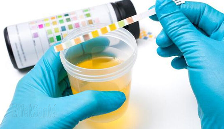 urine, couleur d'urine, urine, maladie