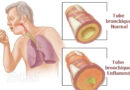 bronchite aiguë, bronchite , pneumonie, maladies respiratoires