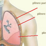 la pleurésie, pleurésie, douleur thoracique, douleur au niveau du thorax