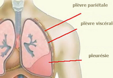 la pleurésie, pleurésie, douleur thoracique, douleur au niveau du thorax