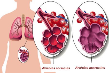 Emphysème pulmonaire, maladie du poumon, maladie pulmonaire, cancer du poumon
