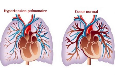 L'hypertension artérielle pulmonaire, L'hypertension pulmonaire,L'hypertension artérielle, hypertension