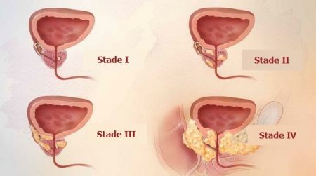 cancer de la prostate, prostate, douleurs abdominales, prostate, toucher rectal
