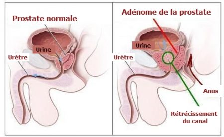 la prostate, toucher rectal , l'hyperplasie bénigne de la prostate, cancer de la prostate, cancer chez l'homme,