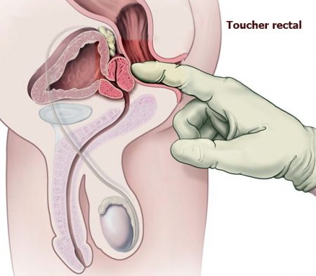la prostate, toucher rectal , l'hyperplasie bénigne de la prostate, cancer de la prostate, cancer chez l'homme,