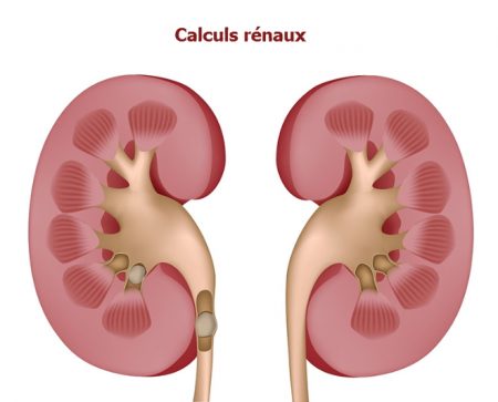 calcul rénal, calculs rénaux, pierres aux reins, pierre rénale