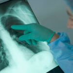 Emphysème pulmonaire, maladie du poumon, maladie pulmonaire, cancer du poumon