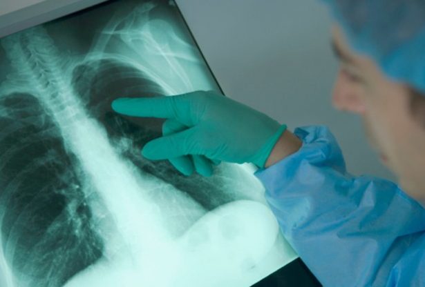 Emphysème pulmonaire, maladie du poumon, maladie pulmonaire, cancer du poumon