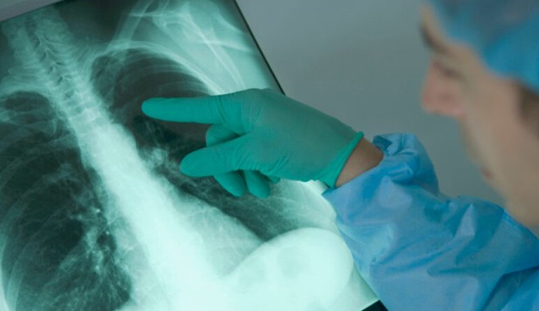 Emphysème pulmonaire, maladie du poumon, maladie pulmonaire, cancer du poumon