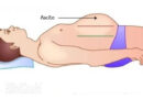 ascite, l'ascite, maladies du ventre, maladies abdominale, foie, maladies du foie, cirrhose