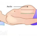 ascite, l'ascite, maladies du ventre, maladies abdominale, foie, maladies du foie, cirrhose