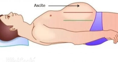 ascite, l'ascite, maladies du ventre, maladies abdominale, foie, maladies du foie, cirrhose