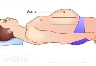 ascite, l'ascite, maladies du ventre, maladies abdominale, foie, maladies du foie, cirrhose