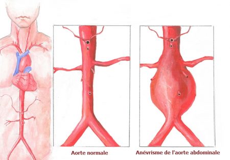 coeur, maladies du coeur, l'aorte abdominale, anévrisme, infarctus du myocarde, infarctus