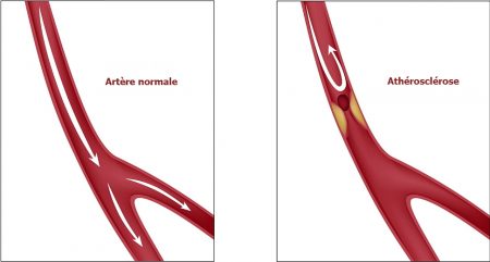 l'athérosclérose, artères malades, les artères, maladies du coeur, infarctus du myocarde, infarctus, AVC