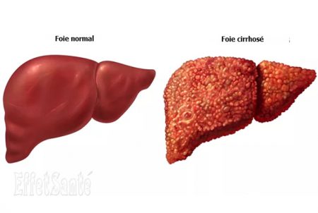 cirrhose hépatique, cancer du foie, maladies du foie, le foie, foie malade, cirrhose