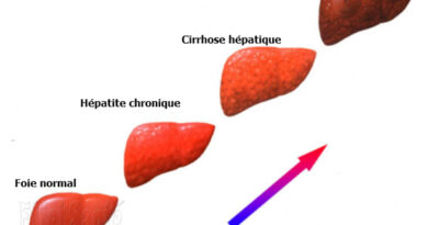 la cirrhose, cirrhose du foie, maladies du foie