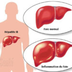 hépatite B, maladies du foie, hépatite, l'hépatite