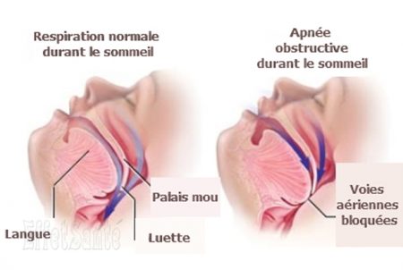 apnée du sommeil, apnée, respiration difficile, poumons malades, poumons, les poumons, les bronches,