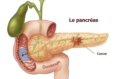 cancer du pancreas, pancréas, le cancer, le pancréas, cancer du pancréas