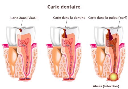 carie dent, maux de dents, douleur dent, carie dentaire, cause carie,