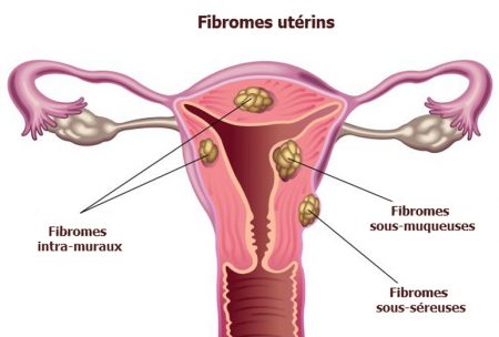 fibrome, fibromes utérins, fibromes, cancer utérin, douleurs abdominales