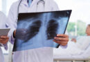 maladies pulmonaire, poumons, cancer du poumon