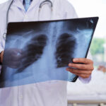 maladies pulmonaire, poumons, cancer du poumon