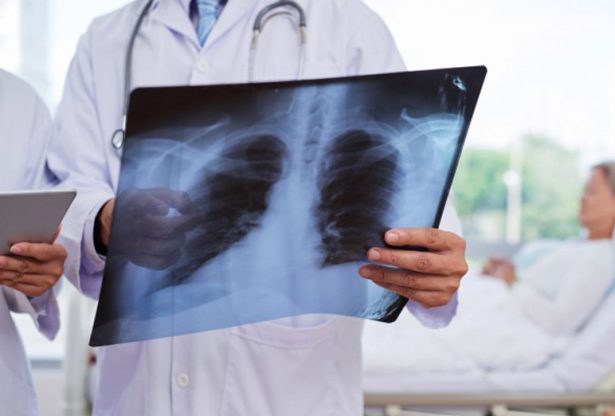 maladies pulmonaire, poumons, cancer du poumon