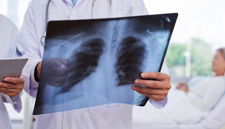 maladies pulmonaire, poumons, cancer du poumon