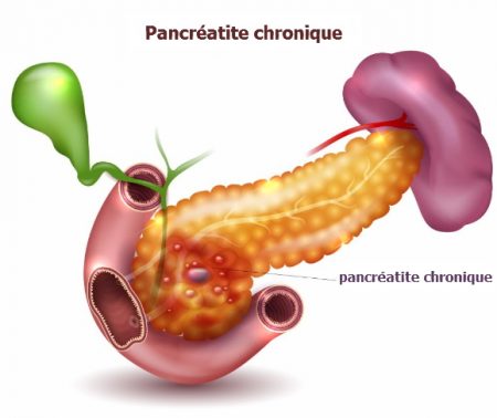 pancréatite, maladies du pancréas, le pancréas, cancer du pancréas