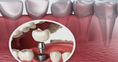 implant dentaire, dents, la dente, contri indication implant dentaire