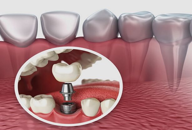 implant dentaire, dents, la dente, contri indication implant dentaire