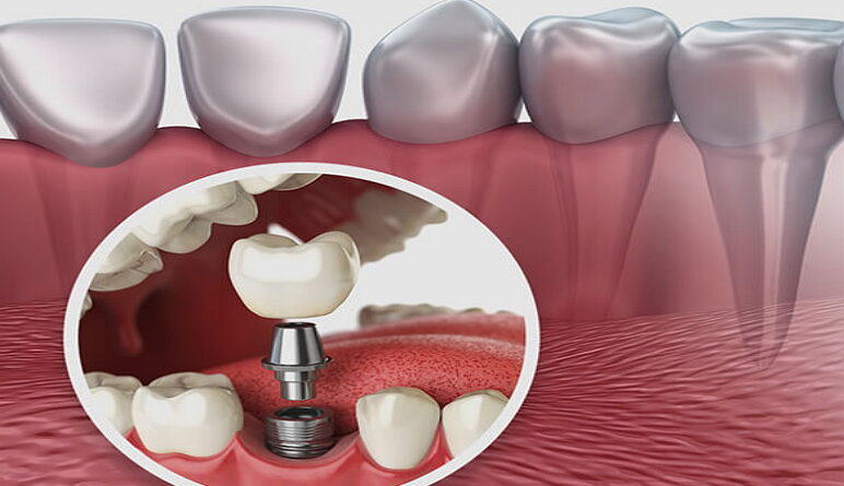 implant dentaire, dents, la dente, contri indication implant dentaire