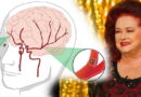 AVC, maladies vasculaires, attaques cérébrale