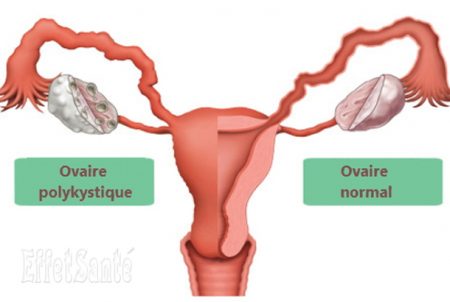 ovaires polykystiques, syndrome des ovaires polykystiques , les ovaires